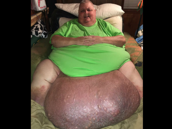 রোগীর দেহ থেকে ৬০ কেজি ওজনের টিউমার কেটে বাদ দিলেন চিকিৎসক রোগীর দেহ থেকে ৬০ কেজি ওজনের টিউমার কেটে বাদ দিলেন চিকিৎসক