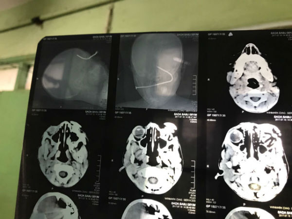 চোখে পেরেক নিয়ে হাসপাতালের দোরে দোরে ঘুরল ৮ বছরের বালক, কী হল তারপর চোখে পেরেক নিয়ে হাসপাতালের দোরে দোরে ঘুরল ৮ বছরের বালক, কী হল তারপর