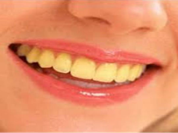 হলদে দাঁত 