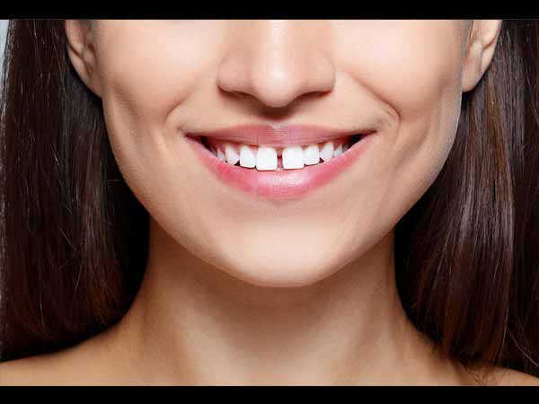 সামনের দাঁতের মাঝে ফাঁক থাকলে কী হয় 