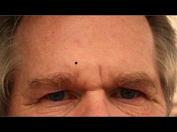 কপালে তিল 