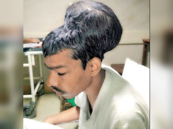 বিশ্বের সবচেয়ে বড় ব্রেন টিউমারের সফল অস্ত্রোপচার মুম্বইয়ে 