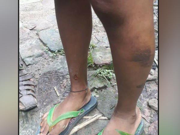 ১০ টাকার জন্য অমানবিক নির্যাতন শিশুকে, গরম খুন্তির ছ্যাঁকা