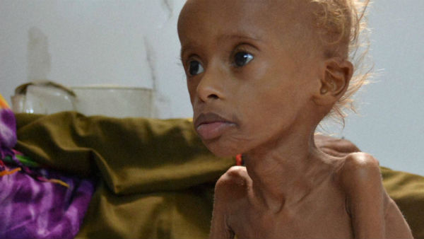 সঠিক পুষ্টি বড় সমস্যা