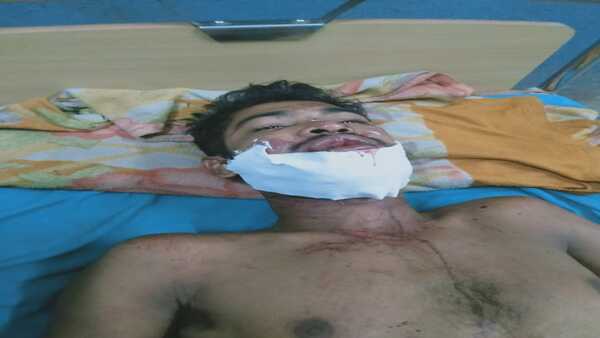 দুর্ঘটনায় চোয়াল ভাঙে রাজকুমারের দুর্ঘটনায় চোয়াল ভাঙে রাজকুমারের