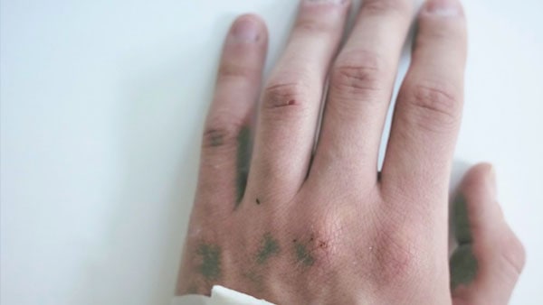 মাঙ্কিপক্সের প্রথম কেস দিল্লিতে