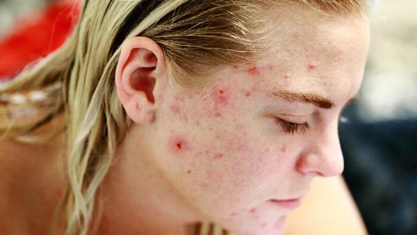 মাঙ্কি পক্সে উপপ্রজাতির সন্ধান মাঙ্কি পক্সে উপপ্রজাতির সন্ধান