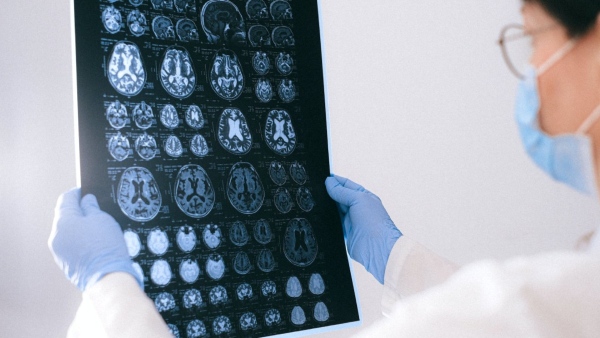 Alzheimers Alzheimers