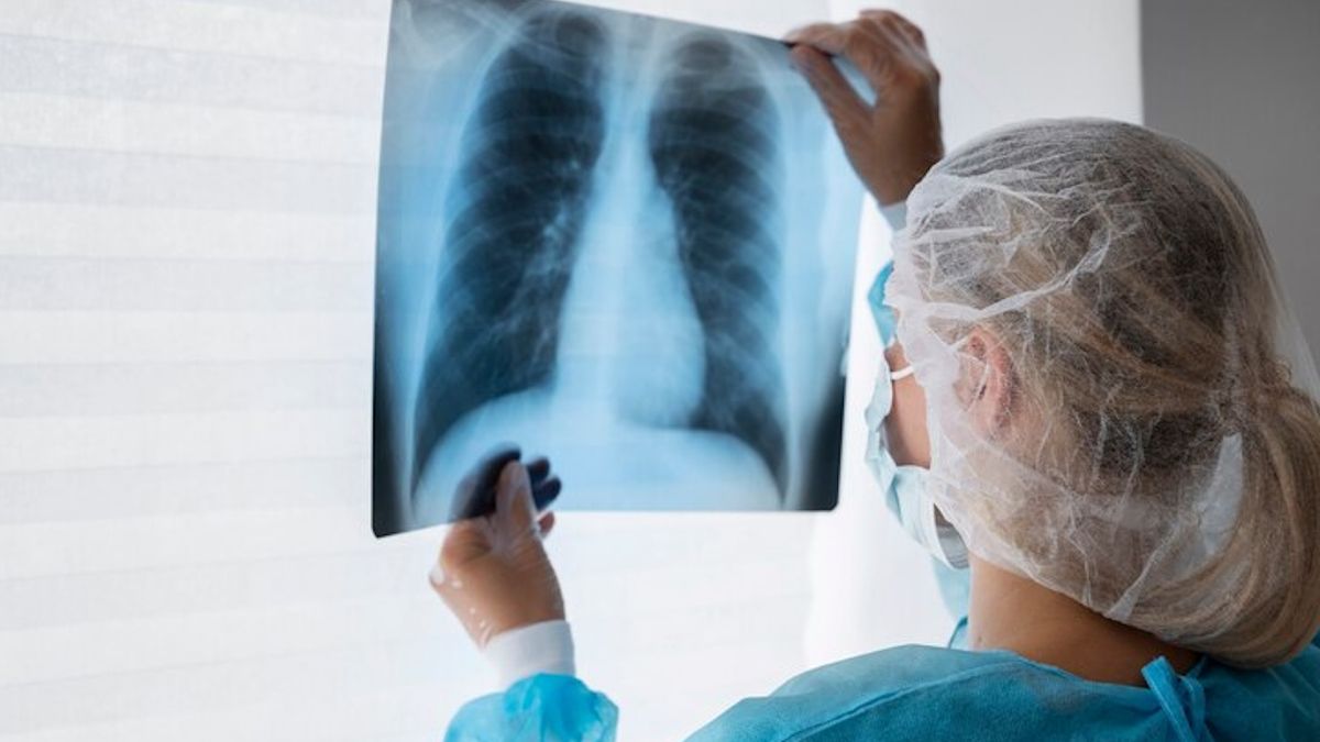 टीबी के मरीजों के लिए राहत की खबर! सरकार ने नए उपचार को दी मंजूरी, मिलेगा सिर्फ 6 महीन में छुटकारा