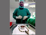 Doctors remove 99 stones from woman’s gallbladder in Karnataka 