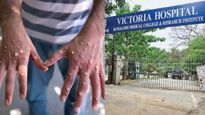Bengaluru: Victoria Hospital Reports First Suspected Monkeypox Case