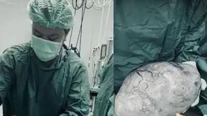 Ovarian Cyst: मोटापे से जूझ रही थी महिला, डॉक्टर के पास गई तो उड़े होश, शरीर में था 9 किलो का सिस्ट 