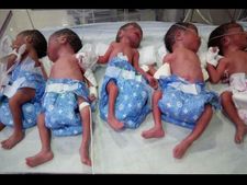 Rare and surprising: Woman gives birth to five babies