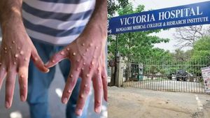 Bengaluru: Victoria Hospital Reports First Suspected Monkeypox Case