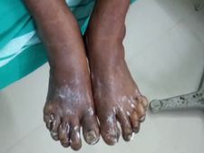 ಕೊಪ್ಪಳ : ಕೊಂಡ ಹಾಯುವಾಗ ಬಿದ್ದು ಇಬ್ಬರಿಗೆ ಗಾಯ