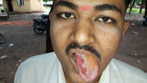 ಗರಿಗರಿ ಚಿಪ್ಸ್ ತಿಂದು ನಾಲಗೆಯನ್ನೇ ಸುಟ್ಟುಕೊಂಡ ಯುವಕ
