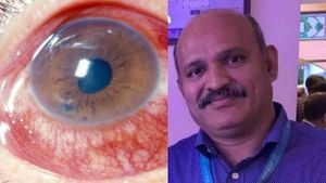  ದಾವಣಗೆರೆ: ಮಕ್ಕಳಲ್ಲಿ ಐ ವೈರಸ್‌ ಸೋಂಕು.!, ರೋಗ ಲಕ್ಷಣಗಳು & ವೈದ್ಯರ ಸಲಹೆಗಳೇನು?