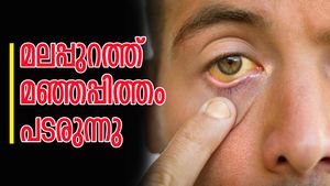 മലപ്പുറത്ത് മഞ്ഞപ്പിത്തം പടരുന്നു; ഇന്ന് മാത്രം റിപ്പോര്‍ട്ട് ചെയ്തത് രണ്ട് മരണം