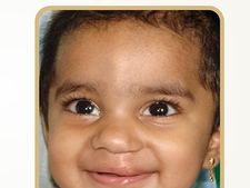 உதட்டு பிளவு, மேல் அன்ன சீரமைப்புக்காக 11,000 இலவச ஆபரேஷன்கள்.. மதுரை மீனாட்சி மிஷன் சாதனை!