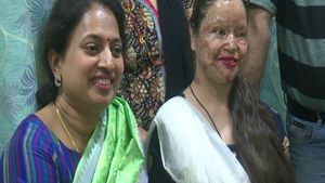 2013-இல் ஆசிட் வீச்சு.. 6 ஆண்டுகளாக மதுரையில் சிகிச்சை..  மனம் தளராத நேபாள பெண் பிந்துபாஷினி 