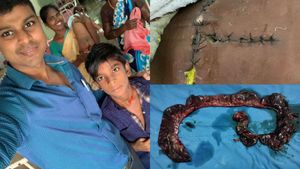 சிறுவன் வயிற்றை கிழித்தால் 1 லி. அழுகிய ரத்தம்! ரிஸ்கான ஆபரேஷன்.. சக்சஸ் செய்த தஞ்சை அரசு ஆஸ்பத்திரி