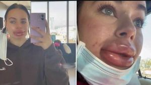 Lip Filler: அழகான உதடுக்கு ஆசைப்பட்ட மாடல் அழகி.. லிப்ஸ் பெரிதாக்கி படுபயங்கரத்தால் கதறும் பெண் 