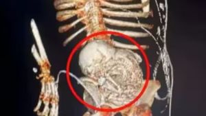 56 வருடமாக வயிற்றில் கருவை சுமந்த பெண்.. எக்ஸ்ரேவில் காத்திருந்த ஷாக்! மருத்துவ உலகில் வினோத சம்பவம் 