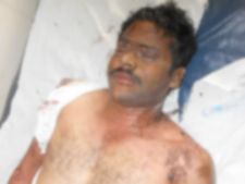  లెక్చరర్ మరో పెళ్లి: ప్రియురాలి యాసిడ్ దాడి (పిక్చర్స్)