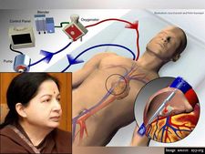జయకు చికిత్స ఇలా: 12 గంటలకు అపోలో ప్రకటన ? (ఫోటో) 