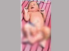 జనగామలో మూడుకాళ్లతో పుట్టిన పాప