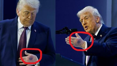 Trump Hand Mark: क्या बीमार हैं डोनाल्ड ट्रंप? दावोस की मीटिंग में हाथ पर दिखा गहरा जख्म, खुद बताई इसकी वजह?