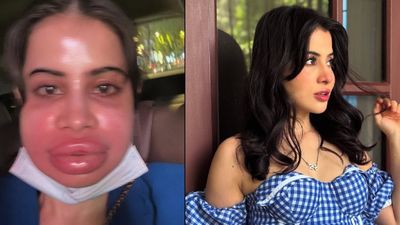“This Is My Real Face”: Urfi Javed Responds To Trolls After Filler Removal