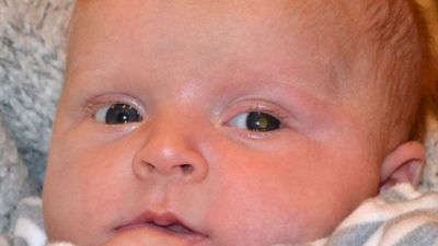 How Clicking Photos Detected Eye Cancer In A 10-Month-Old Child: Retinoblastoma Explained