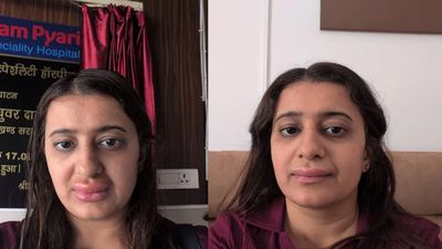 വന്ദേ ഭാരതിൽ നിന്നും ഭക്ഷണം കഴിച്ചു, പിന്നാലെ ഗുരുതര അലർജി; ചിത്രങ്ങൾ പങ്കുവെച്ച് യുവതി