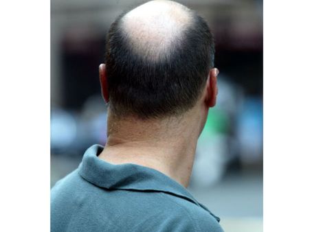 চুল নেই, মান তো আছে, রাহুল গান্ধীর মন্তব্যে গোঁসা 'টাকবাবু'-দের