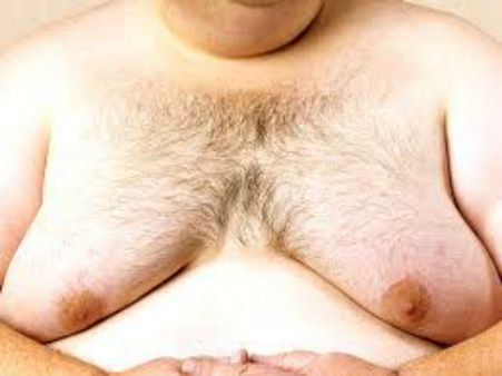 (ছবি) পুরুষ 'স্তন'-এর ক্রমবর্ধমান সমস্যায় চক্ষু চড়কগাছ চিকিৎসকদের!