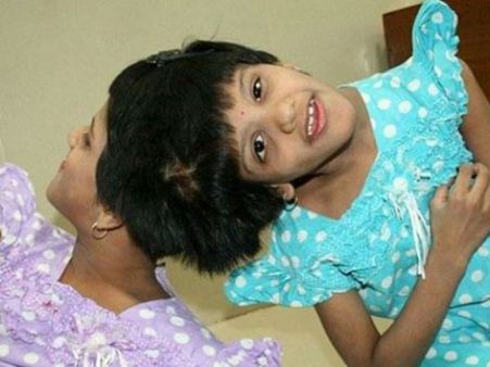 এক দশকের লড়াই বিফলে, মাথা আলাদা হবে না তেলেঙ্গানার দুই বোনের