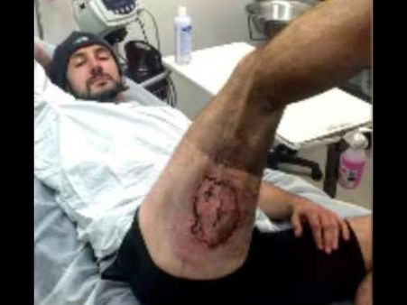 পকেটে রাখা iPhone 6 ফেটে বিপত্তি, গুরুতর আঘাত নিয়ে যেতে হল হাসপাতালে