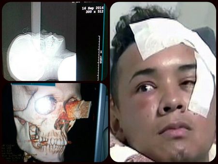 বোনের বয়ফ্রেন্ডের মারা ছুরি চোখ দিয়ে ঢুকে মস্তিষ্ক ভেদ করে বেরল, তবু সুস্থ ছেলেটি!