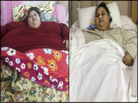 বিশ্বের সবচেয়ে ভারি মহিলা ইমান আহমেদ ২ মাসে ২৪২ কেজি ওজন কমিয়েছেন