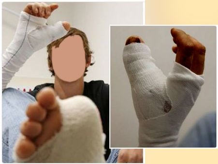 পায়ের আঙুলে ফিরল বাদ যাওয়া হাতের আঙুল