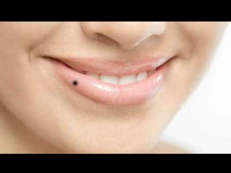 আঁচিল চিনতে ভুল হলে ক্যানসার হতে পারে, সতর্কতা জরুরি