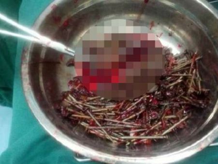 মেডিকেলে জটিল অস্ত্রোপচার, রোগীর পেটে মিলল ৬৩৯ টি পেরেক