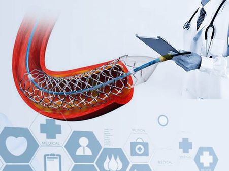 মানের দিক দিয়ে বিদেশি স্টেন্টের সমগোত্রীয় ভারতীয় স্টেন্ট! দাবি এক গবেষণায়