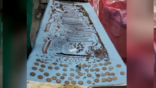 তরুণীর পেট কেটে উদ্ধার দেড় কেজি ওজনের গয়না, তাজ্জব কাণ্ড বীরভূমে