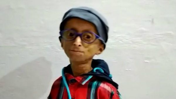 ‌করোনা কি অ্যায়সি ত্যায়সি, বাড়িতে থেকে সুরক্ষিত থাকার পরামর্শ প্রোজেরিয়া শিশুদের