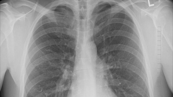 রক্তের পর এবার জীবিত মানুষের ফুসফুসে মিলল প্লাস্টিকের কণা, উদ্বেগ বাড়ছে ক্রমশঃ