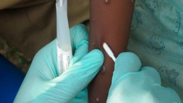 কাদের মাঙ্কিপক্সে আক্রান্ত হওয়ার সম্ভাবনা বেশি, জানেন?