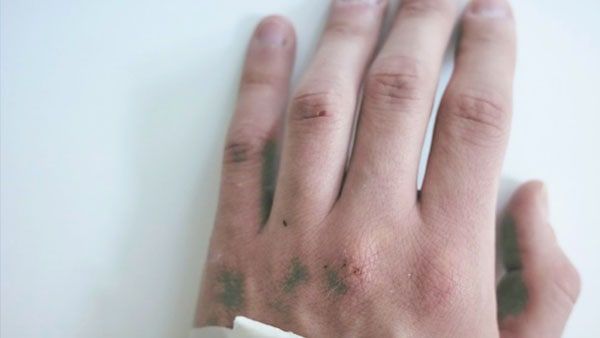 অবাক কাণ্ড, কোভিড - এইডস - মাঙ্কিপক্স, একসঙ্গে তিন রোগে আক্রান্ত এই ব্যক্তি