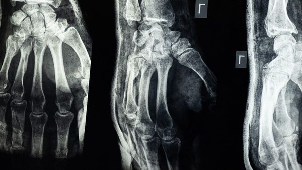 Drinks For Healthy Bones: হাড় মজবুত রাখতে ডায়েটে রাখুন এই জুসগুলি